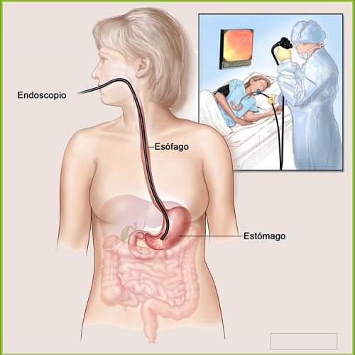 Vídeo Endoscopia Digestiva Alta