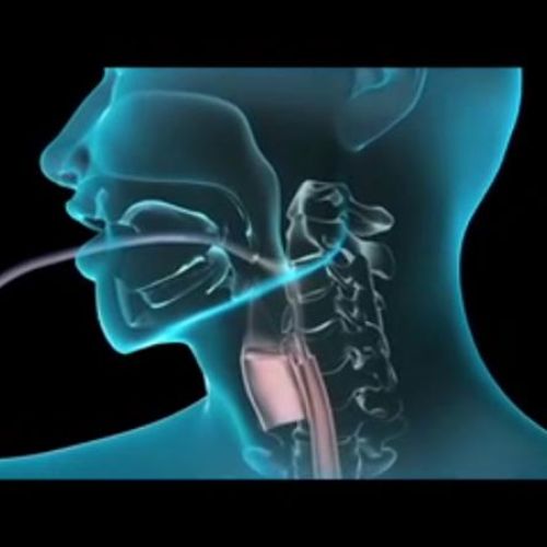Vídeo Endoscopia Digestiva Alta
