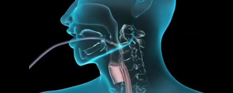 Vídeo Endoscopia Digestiva Alta
