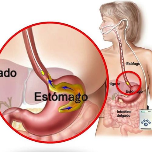 pH Metria de Esôfago