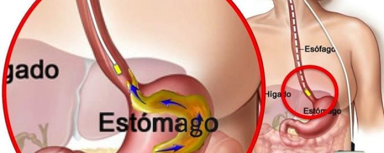 pH Metria de Esôfago