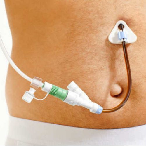 Gastrostomia Endoscópica
