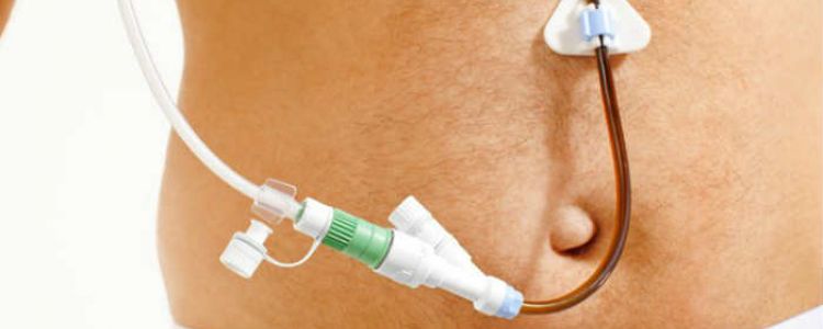 Gastrostomia Endoscópica